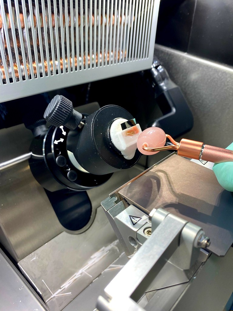 A green gloved hand presses a pink jade beauty roller against the piece of tape on the same block, reducing strain on thumb joint in a cryostat.